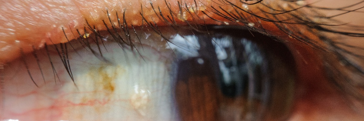 Close up of eye with blepharitis condition